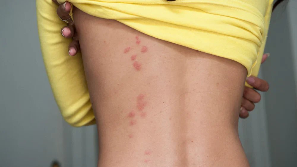 Bed bugs battle - OSCARLIVING