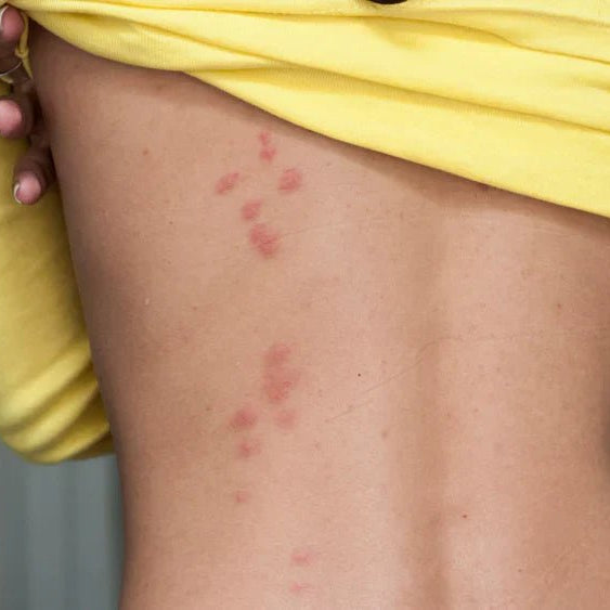 Bed bugs battle - OSCARLIVING